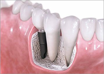 Все, что нужно знать об установке зубного имплантата. Часть 1