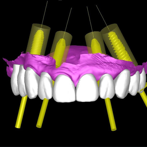 Несъемные зубные протезы на 4-х имплантах All-on-4